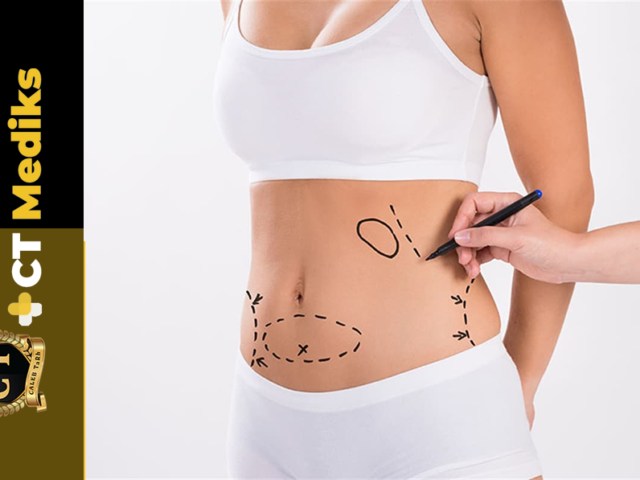 Types Of Liposuction In Istanbul