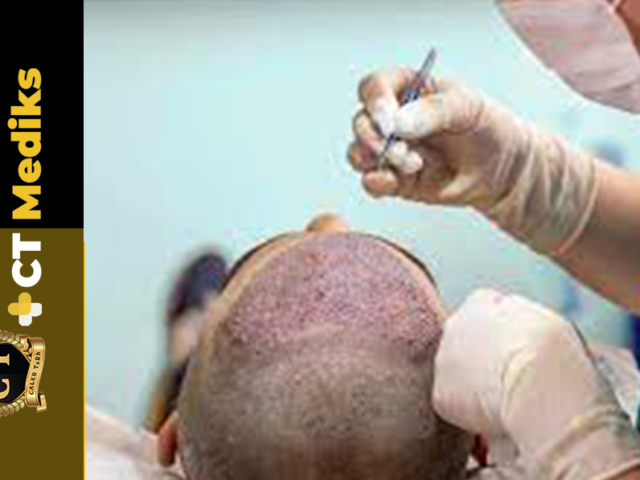 Which Is Better: FUE Or DHI Hair Transplant In Turkey?